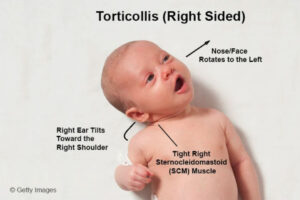 What you need to know about torticollis